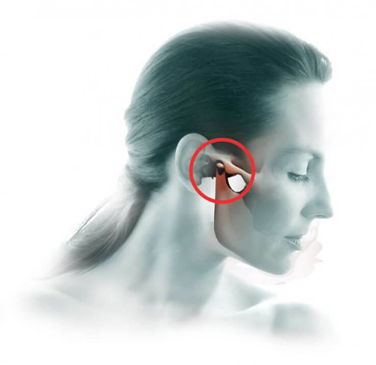 Jaw Joint Treatment (TME Treatment)