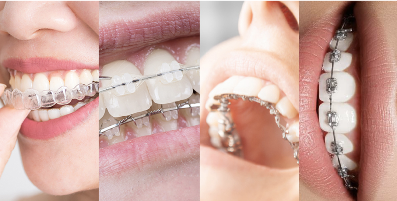 Orthodontic Treatment